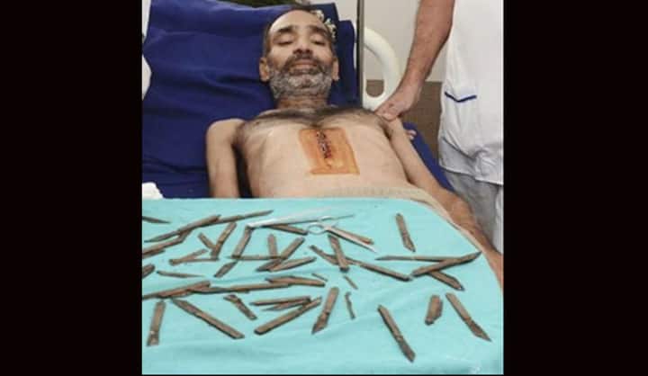 पेट में दर्द की शिकायत लेकर अस्पताल पहुंचे सुरजीत का वजन काफी कम हो गया था. घंटो तक चले ऑपरेशन में हेड कांस्टेबल के पेट से 40 चाकू निकाले गए.