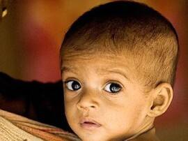 बिहार में कुपोषित बच्चों की संख्या सर्वाधिक Malnutrition On The Rise In Bihar Report बिहार में कुपोषित बच्चों की संख्या सर्वाधिक
