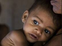 मध्यप्रदेश के गांव में कुपोषण से 12 बच्चों की मौत