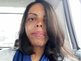 तेजाब 2 : जिसका चेहरा नहीं देखते थे लोग, वो संवार रही है खूबसूरती