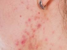 चिकनगुनिया के बाद त्वचा पर रैशेज से यूं पाएं छुटकारा