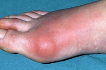 पैर के अंगुठे में दर्द कहीं इस वजह से तो नहीं! 