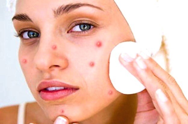 Pimple Treatment Know Home Remedies & Lifestyle Tips From Dr. Abhishek De Pimple Treatment Home Remedy : ব্রণ সারাতে চান ঝটপট? জেনে নিন সহজ টিপস