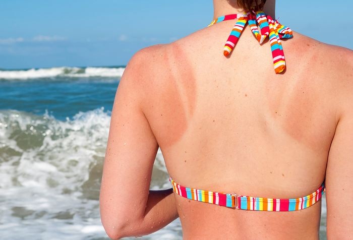 sunburn fast home remedies to remove tanning   તડકામાં કાળી પડી ગઈ છે સ્કિન, તાત્કાલિક રાહત મેળવવા કરો આ ઉપાય, ટેનિંગ થશે દૂર