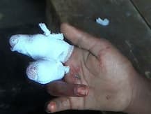 यूपी: खेत से दो पत्तियां तोड़ने पर काट दी दलित लड़की की दो उंगलियां!