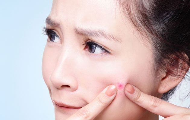 How To Get Rid Of Pimples Fast पिंपल्‍स से बचने के लिए जरूर काम आएंगे ये टिप्‍स!