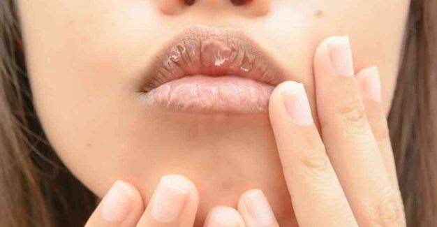 Home Remedies To Treat Chapped Lips विंटर्स में फटे होठों से बचने के लिए यूं करें केयर