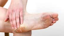 पैरों की रूखी त्वचा से निजात पाने के लिए अपनाएं ये उपाय