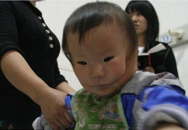 चीन की एक एजेंसी ने बताया कि जब Huikang की मां ने बच्चे को पहली बार देखा था तब उसे सदमा लगा था. काफी समय तक डॉक्टर्स ने Huikang की मां को उसे नहीं देखने दिया था. Huikang के परिवार वालों को समाज के उपहास का भी सामना करना पड़ा. 