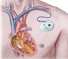 10 साल तक बिना रूके काम करेगा दुनिया का ये सबसे छोटा पेसमेकर!