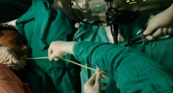 Doctors Remove 6 Foot Long Tapeworm From Mans Gut दिल मजबूत हो तभी पढ़ें ये खबर और वीडियो देखें!!!