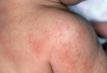 गर्मियों में बचना है घमौरियों से अपनाएं ये टिप्स!