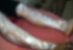 यूपी: संभल में पत्नी पर तेजाब से हमला, आरोपी पति गिरफ्त से बाहर