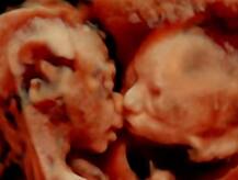 OMG! गर्भ में एक-दूसरे को किस कर रहा है ये भ्रूण