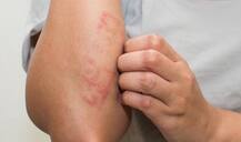 सावधान! मानूसन में हो सकती हैं स्किन प्रॉब्लम्स