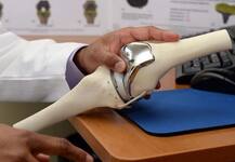 ‘नी रिप्लेसमेंट’ के दामों में कटौती अच्छा कदम, अब गुणवत्ता पर भी ध्यान देने की जरूरत