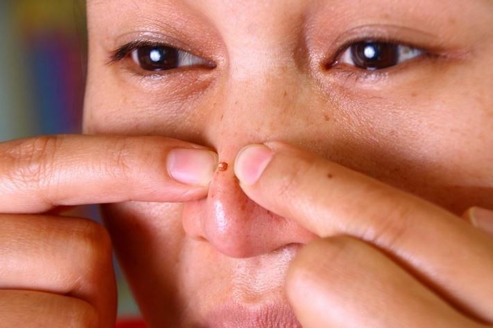Health Tips: Blackheads Are Spoiling Your Facial Beauty, Know How to Get rid of it Health Tips: खूबसूरती पर न लगने दें ब्लैकहेड्स का धब्बा, अपनाएं ये उपाय