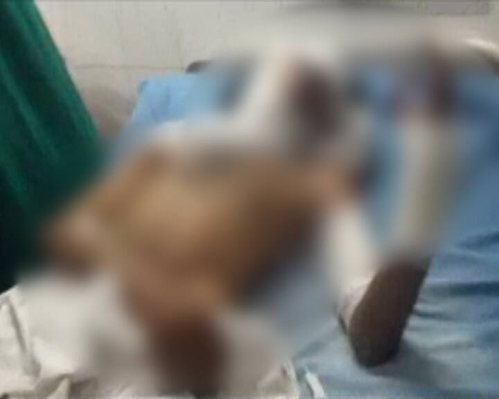 Aligarh Woman Throws Hot Water On Husband For Not Shaving दाढ़ी नहीं बनाई तो पत्नी ने डाल दिया खौलता पानी, पति अस्पताल में भर्ती