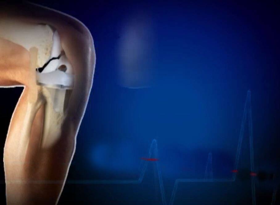 Knee Implants To Cost Up To 70 Less As Government Caps Prices 2 घुटने के दर्द से परेशान लोगों के लिए आई अच्छी खबर, सस्ता होगा इलाज!