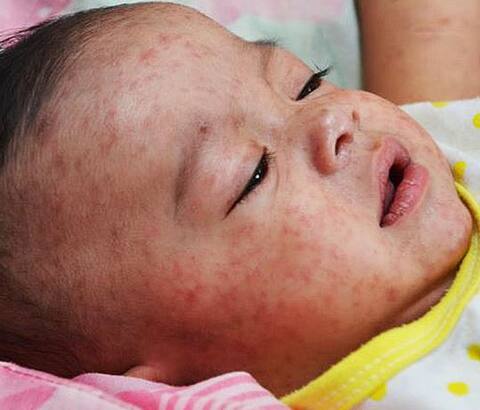 खसरे से मुकाबले में बहुत पीछे हैं भारत और इंडानेशिया: डब्ल्यूएचओ खसरे से मुकाबले में बहुत पीछे हैं भारत और इंडानेशिया: डब्ल्यूएचओ