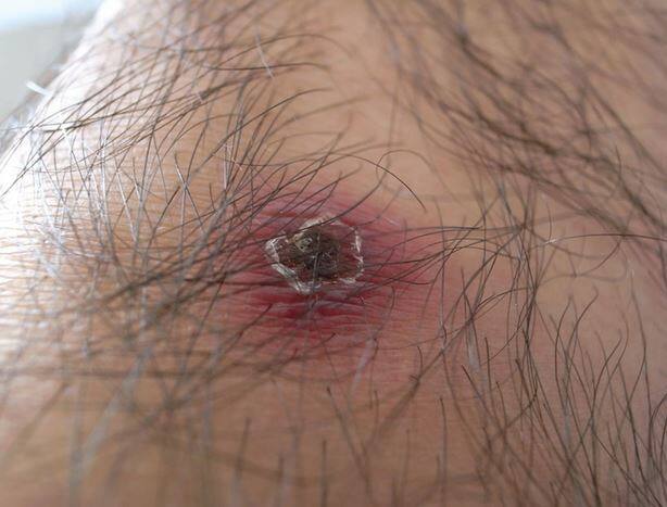हिमाचल प्रदेश में स्क्रब टाइफस से हो रही हैं मौतें Two More Die Of Scrub Typhus In Himachal Pradesh हिमाचल प्रदेश में स्क्रब टाइफस से हो रही हैं मौतें