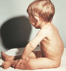 21 महीने के बच्चे की रीढ़ की हड्डी का सफल ऑपरेशन, देश का पहला ऐसा मामला