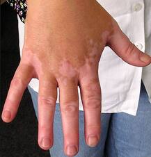 डायबिटीज है तो हो सकती है ये स्किन प्रॉब्लम