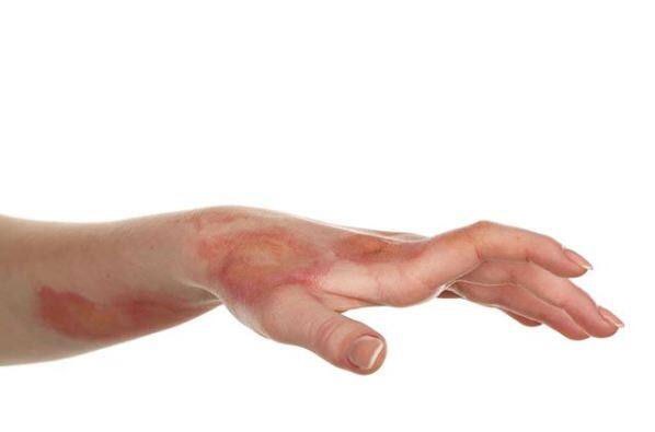 डियोड्रेंट चैलेंज- डियोड्रेंट चैलेंज में लोगों को अपने हाथों या फिर शरीर के किसी भी हिस्से तब तक डियोड्रेंट से स्प्रे करते रहते हैं जब तक वो उसे बर्दाश्त कर पाते हैं. इसकी चपेट में भी कई बच्चे आएं. इस चैलेंज में बच्चों की स्किन सेकेंड डिग्री तक का बर्न तक हो गई. फोटोः इंस्टाग्राम