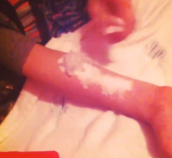 साल्ट और आइस चैलेंज- इस चैलेंज में टींस को अपनी स्किन पर नमक लगाकर बर्फ रखती थी और देखना था कि वे कितनी देर तक बर्निंग सेंसेशन को बर्दाश्त कर सकते हैं. इस दर्दनाक चैलेंज से टींस सेकेंड डिग्री तक बर्न हो गए. उनके शरीर पर हमेशा के लिए निशान पड़ गए. फोटोः इंस्टाग्राम