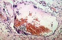 ऐसे फलों को खाने से हो सकता है Nipah virus, बचने के लिए अपनाएं ये उपाय