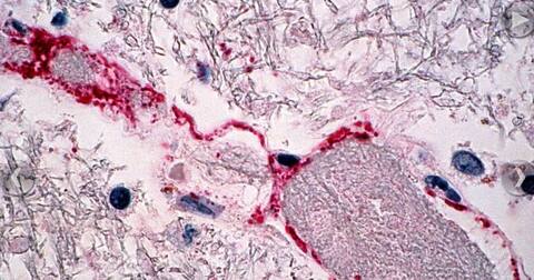 Nipah Virus के बारे में ये बातें जानना है बेहद जरूरी