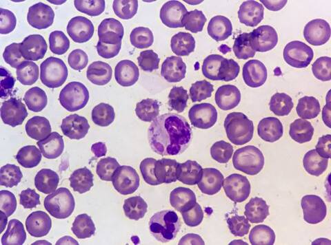 Nipah Virus के बारे में ये बातें जानना है बेहद जरूरी