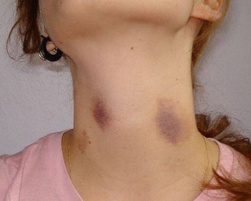  इसे नॉन मेलेनोमा त्वचा कैंसर के रूप में पहचाना गया है. कई देशों में यह बाहर काम करने वाले मजदूरों में व्यवसाय से जुड़ी हुई बीमारी है. हालांकि, बाहर के   व्यवसाय विभिन्न प्रकार की दैनिक गतिविधियों और अल्ट्रावॉयलेट विकिरण के संपर्क में आने से जुड़े हैं. फोटोः गूगल फ्री इमेज 