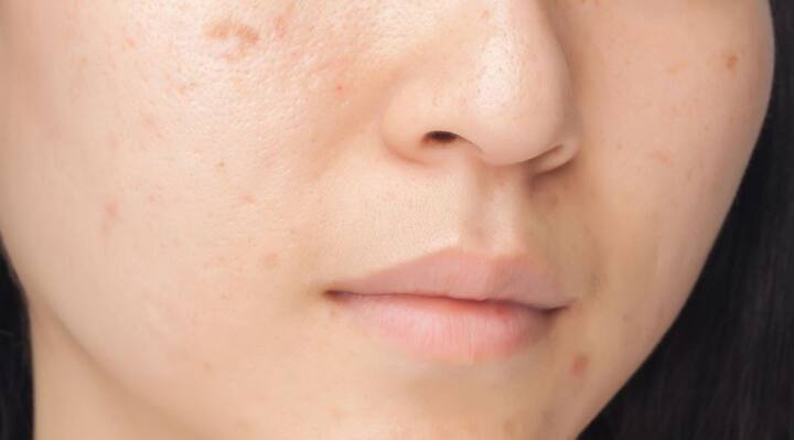 बता दें कि पिंपल्स आम तौर पर ऑयली फेस पर होते हैं. दरअसल सीबम नाम का एक कीटाणु चेहरे पर मौजूद डेड सेल के साथ मिक्स हो जाता है. (फोटो: गूगल फ्री इमेज)