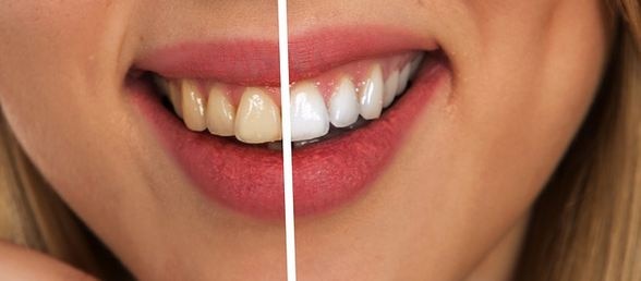 Why do teeth turn yellow? Here's how to make your teeth white and clean ਕਿਉਂ ਪੀਲੇ ਹੋ ਜਾਂਦੇ ਹਨ ਦੰਦ? ਇੰਝ ਬਣਾਓ ਆਪਣੇ ਦੰਦਾਂ ਨੂੰ ਚਿੱਟੇ ਤੇ ਸਾਫ 