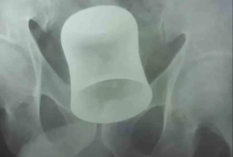 प्राइवेट पार्ट से पेट में पहुंच गया स्टील का ग्लास, बदमाशों ने लूटपाट कर बुजुर्ग के साथ की थी हैवानियत