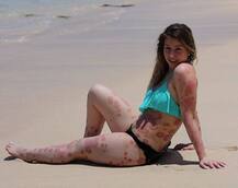 इस लड़की को है ऐसी बीमारी देखकर कोई भी डर जाए, लेकिन ये लड़की बिंदास बिकनी में पोस्ट कर रही है तस्वीरें