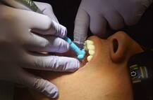 Indore News: 10 वर्षीय बालक के मुंह में थे 50 दांत, सर्जरी के जरिये 30 बेडौल दांत निकाले गए