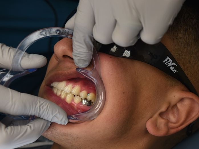 not only your teeth but cavity can damage your oral health be aware Cavity: अनदेखा करने पर खतरनाक रूप ले सकती है कैविटी, जानें बचाव के उपाय