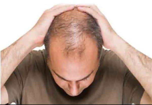 सबसे पहले आमतौर पर ये देखा गया है कि कीमोथेरेपी से आपके बाल झड़ने शुरू हो जाते हैं. तस्वीर: गूगल फ्री इमेज