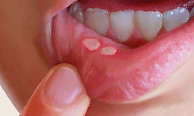  इस कीमोथेरेपी से मुंह में छाले भी हो जाते हैं. तस्वीर: गूगल फ्री इमेज