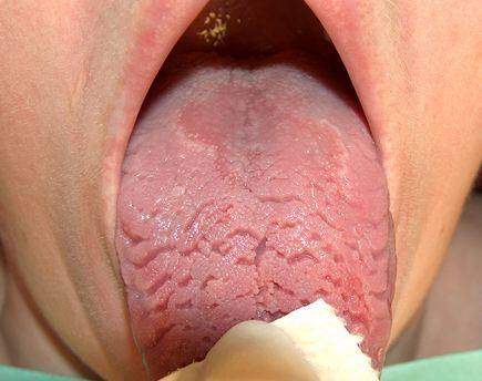 मेडिकल की भाषा में इसे ब्लैक हेयरी टंग कहा जाता है. हालांकि डॉक्टर कहते हैं ये कंडीशन कुछ समय के लिए होती है और इसका कोई नुकसान भी नहीं होता. एक समय ऐसा भी आता है जब ये ग्रीन, यैलो और व्हाइट भी हो जाती है. फोटोः गूगल फ्री इमेज