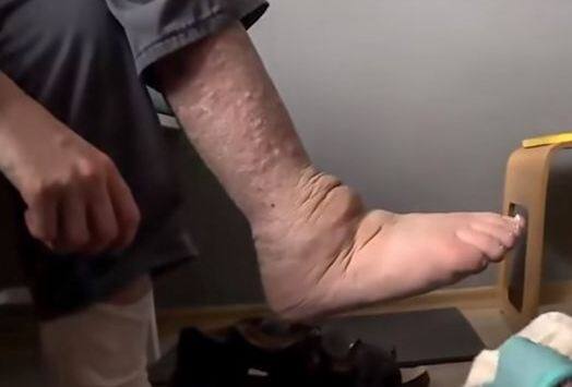 कई सालों तक डॉक्टर्स उसकी बीमारी का पता नहीं लगा पाए. जबकि कुछ ने यहां तक कह दिया कि टॉम फीजिकल नहीं बल्कि मेंटल प्रॉब्लम है. बहुत समय बाद पता चला टॉम का फैब्रिक डिजीज है जिसमें किडनी, हार्ट और स्किन इफेक्ट होते हैं. मेडिकल के मुताबिक, इस बीमारी में लेसोसोमल स्टोरेज डिस्ऑर्डर भी कहा जाता है. पेट, पैरों और शरीर के दर्द को दूर करने के लिए पेनकिलर्स खाने पड़ते हैं. फोटोः सीईएन