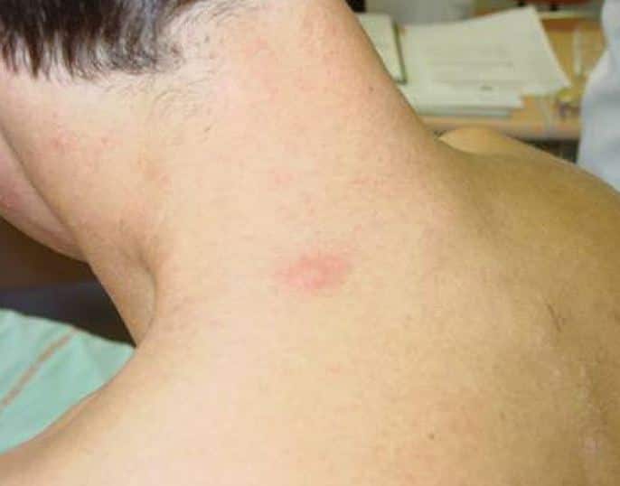 इस बीमारी का इलाज बहुत महंगा होता है और दवाएं लाइफटाइम चलती हैं. ऐसे में टॉम को अब फ्री में इलाज दिया जा रहा है क्योंकि ये बहुत ही रेयर कंडीशन है. फोटोः गूगल फ्री इमेज  
