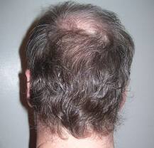 गंजापन दूर करने के लिए लोग अपनाते हैं ऐसी-ऐसी हैरतअंगेज तरकीब