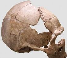 पुणे में 4 साल की बच्ची का हुआ स्कल ट्रांसप्लांट, देश में पहली बार हुई है ऐसी सर्जरी