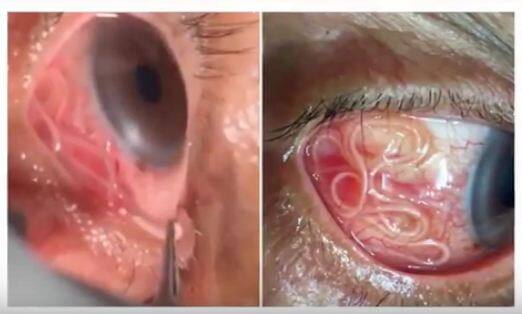 डॉक्टर्स ने बताया कि यदि ऑपरेशन करके इस पुरुष की आंख से इस कीड़े को नहीं निकालते तो वो कभी देख नहीं पाता. हालांकि अभी ये पुरुष रिकवर कर रहा है. फोटोः यूट्यूब 