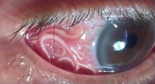 डॉक्टर्स मानते हैं कि ये दुर्लभ मामलों में से एक हैं क्योंकि आंख के अंदर काटने वाले मच्छर आम नहीं है. इस मामले में मच्छर का लार्वा रक्त में प्रवाह हो रहा है और शरीर के अंदर ये बढ़ना शुरू हो गया है. फोटोः यूट्यूब 