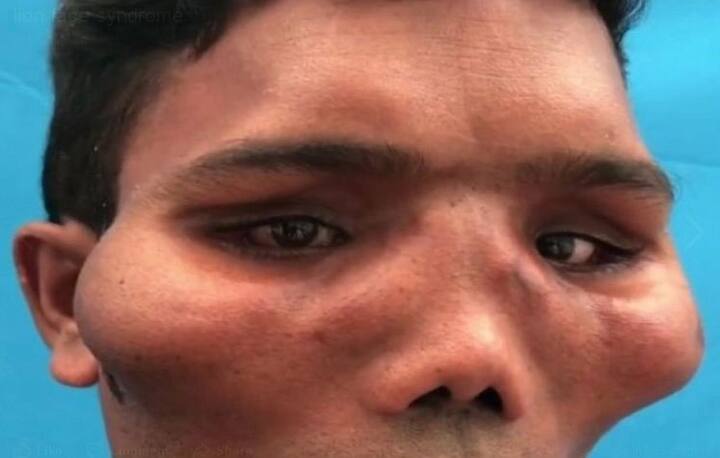 जी हां, इस पुरुष ने कोई प्लास्टिक सर्जरी नहीं करवाई थी बल्कि इसको एक मेडिकल कंडीशन के तहत ऐसा होता था. फोटो: यूट्यूब