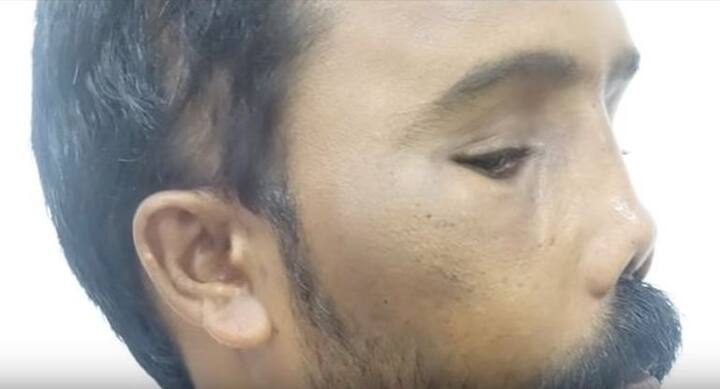 आपको बता दें, सुरेश की ये सर्जरी डॉ. रिचर्डसन ने मुफ्त में की है क्योंकि इस सर्जरी का खर्चा सुरेश नहीं उठा सकता था. लेकिन सुरेश को सिर्फ अपनी दवाओं का पैसा देना होगा. फोटो: यूट्यूब